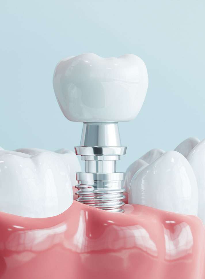Dental Implants