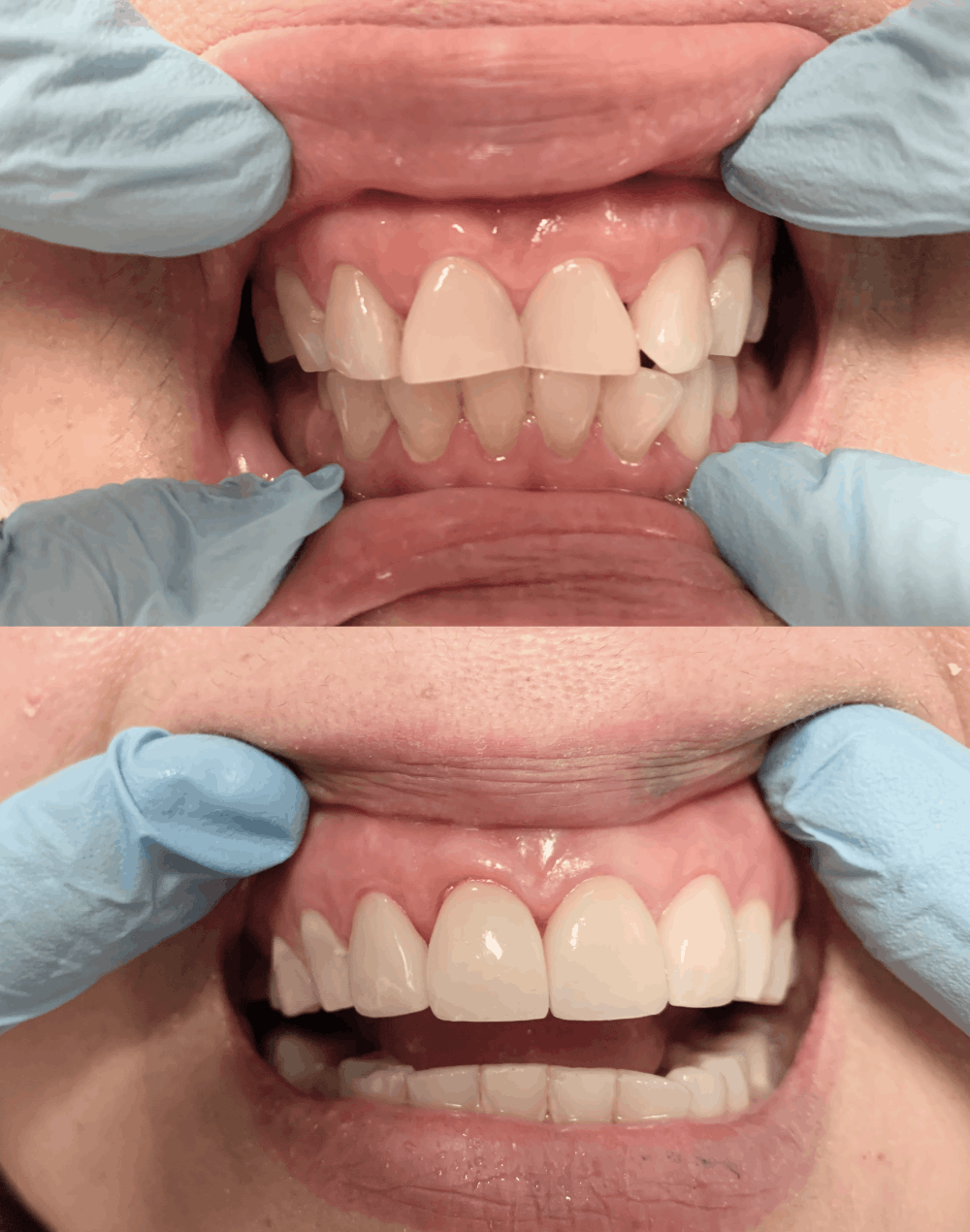 Uneven and Misshapen Teeth Corrected with Porcelain Veneers
